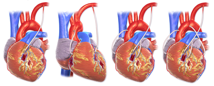 PCI vs. CABG kod dijabetičara – nova studija