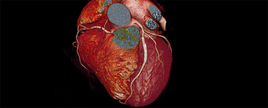 CT koronarna angiografija vs. funkcionalni testovi