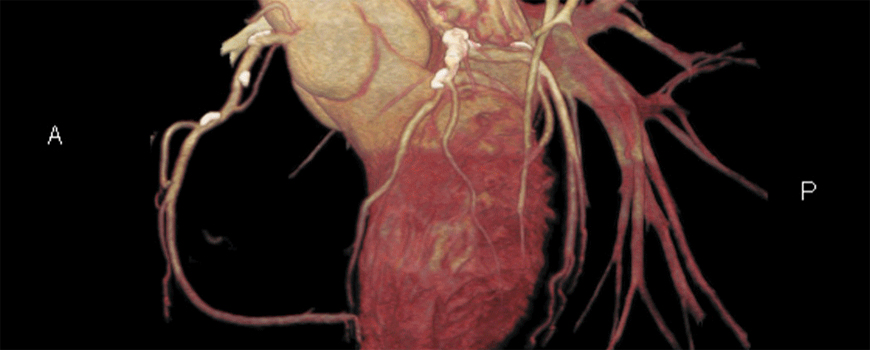 PROSPECT studija: CT angiografija vs. MPI