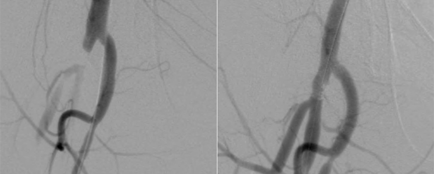 LEVANT 2 – angioplastika balonom obloženim lekom