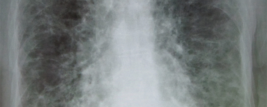 Nove preporuke za lečenje idiopatske pulmonalne fibroze