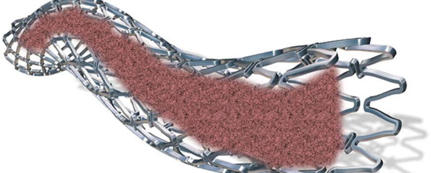 DES in-stent restenoza