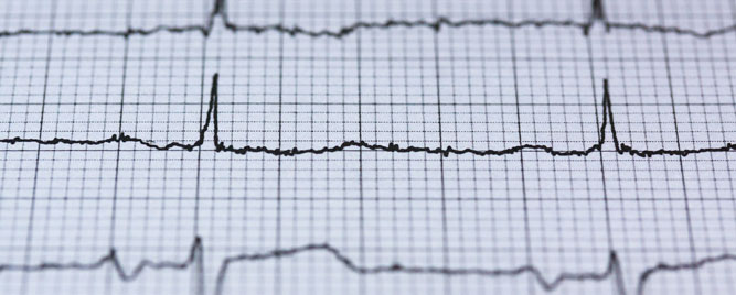 Pozitivan test fizičkim opterećenjem, negativan stres-eho test: šta nam to govori?