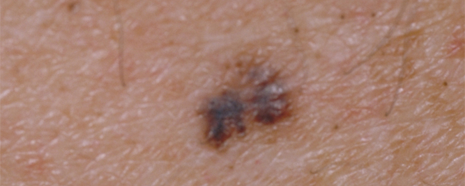 Prediktori metastaziranja melanoma u ranim stadijumima