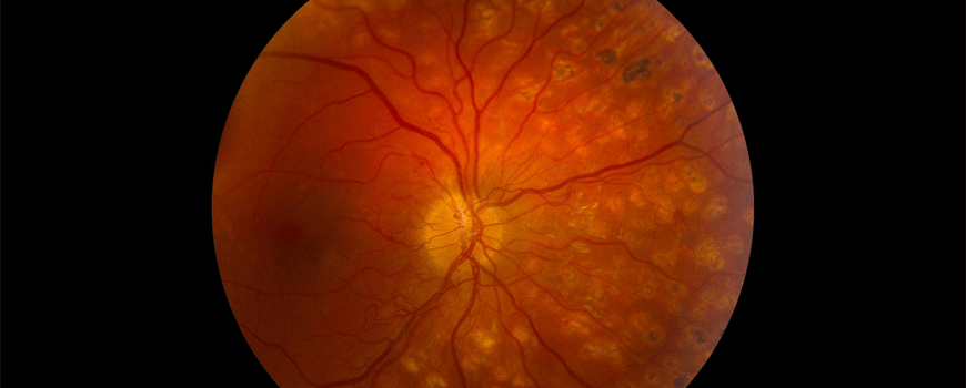 Vitrektomija kod dijabetičke proliferativne retinopatije