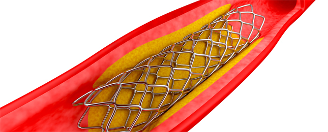 Neoateroskleroza kod tromboze koronarnog stenta