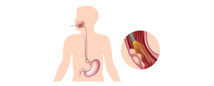 Postoperativna hemoterapija vs. opservacija kod gastroezofagealnog karcinoma