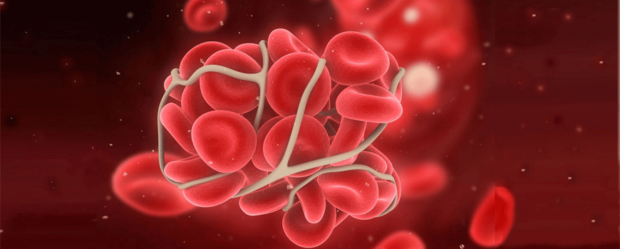 Pravastatin u terapiji antifosfolipidnog sindroma