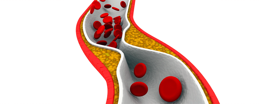 PCI kod stabilne angine pectoris