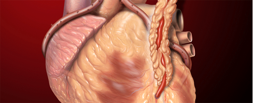 Diabetes mellitus i CABG