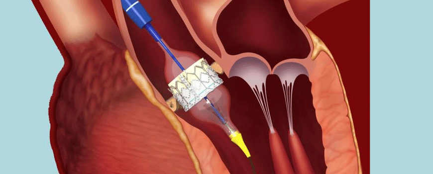 Izdržljivost aortne valvule nakon TAVR