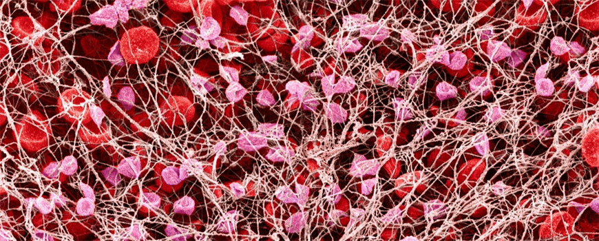 Kangrelor vs. GPIIb/IIIb inhibitori kod PCI