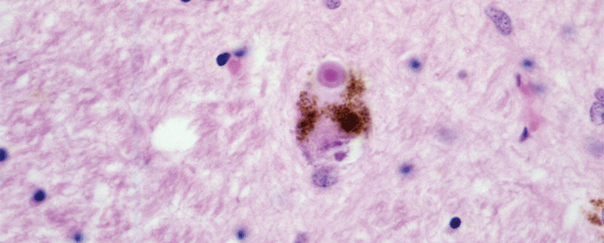 Nova metoda za dijagnostikovanje Parkinsonove bolesti