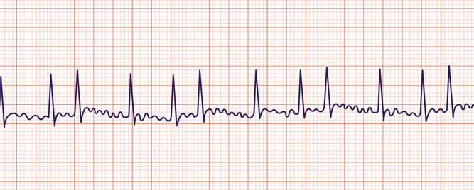 Implantabilni loop recorder kao skrining AF – bez kliničkog značaja