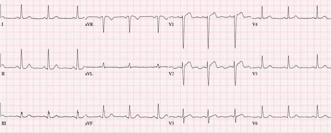 AF ne utiče na efekte sakubitril/valsartana kod HFpEF