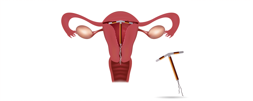 Intrauterina kontracepcija kao prevencija karcinoma grlića materice