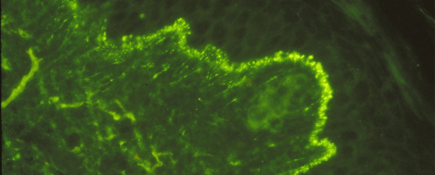 Rituksimab i dermatitis herpetiformis