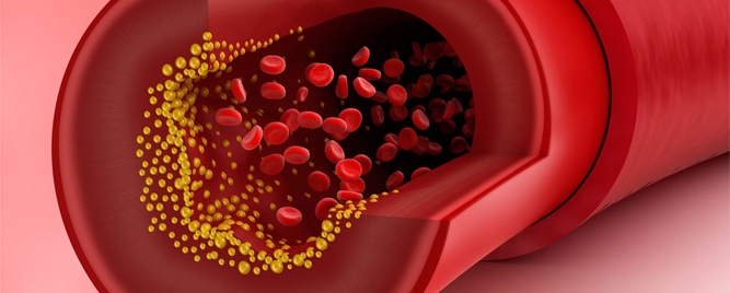 Niži LDL-holesterol, veći rizik od intracerebralne hemoragije