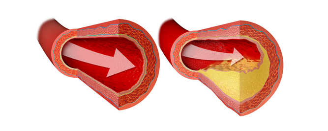 Trosudovna koronarna bolest/bolest glavnog stabla: PCI vs. CABG nakon 10 godina