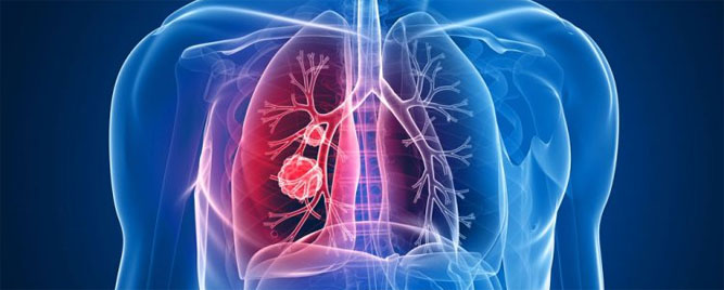 Atezolizumab kod pacijenata sa sitnoćelijskim karcinomom pluća