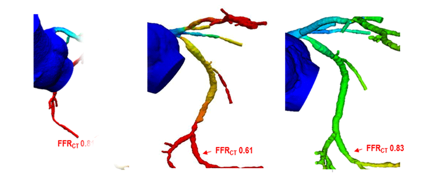 FFR-CT u PLATFORM studiji