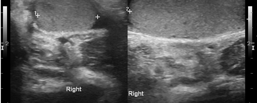 Utrazvučni pregled kod kriptorhizma