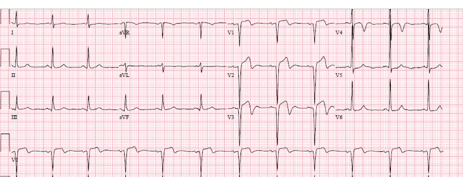 Tranzitorni STEMI – neposredna ili odložena revaskularizacija?