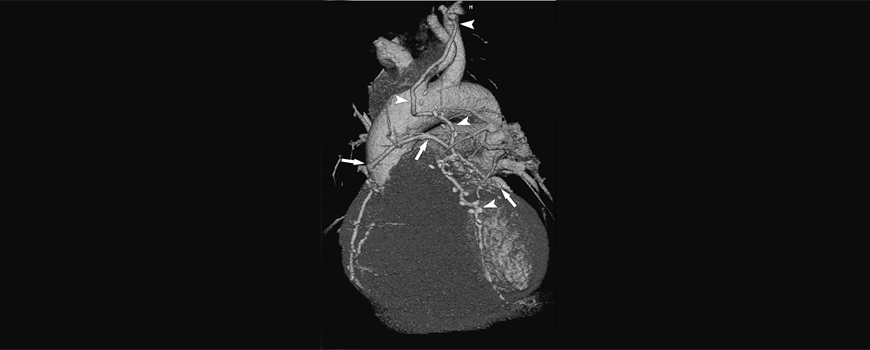 CT angiografija kod suspektne koronarne bolesti