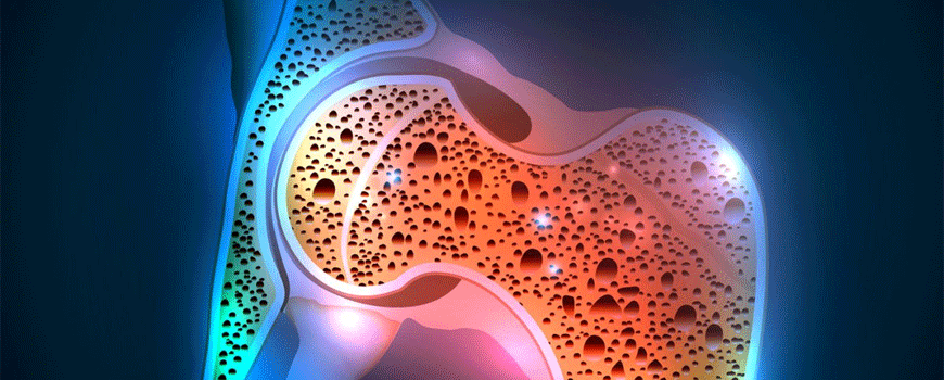 Risedronat vs. teriparatid kod teške posmenopauzalne osteoporoze