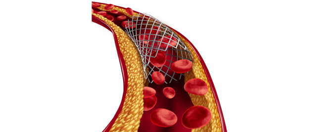 Protrombogenost COVID-19: tromboza koronarnog stenta, VTE