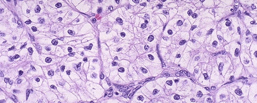 Sunitinib kod lokalizovanog karcinoma bubrega