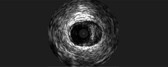 Intravaskularni ultrazvuk pred PCI kod pacijenata sa akutnim koronarnim sindromom