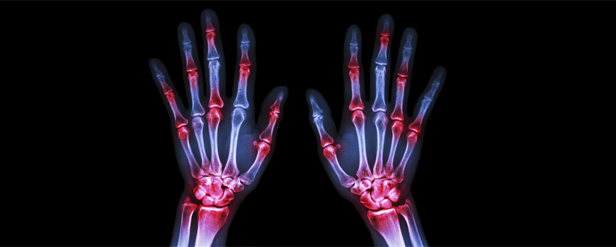 Baricitinib u terapiji reumatoidnog artritisa