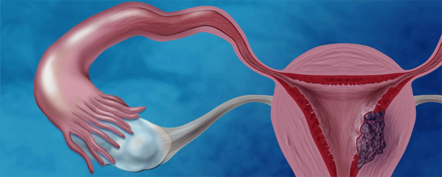 Kardiovaskularni rizik nakon karcinoma endometrijuma