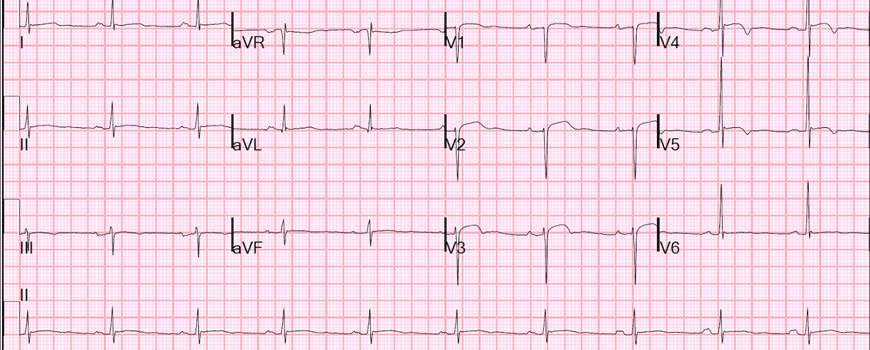 NSTEMI: rana ili odložena revaskularizacija?