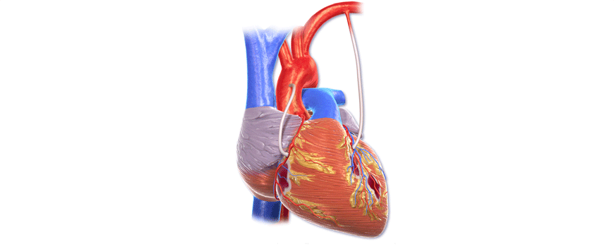 Mutlipli arterijski graftovi vs. LIMA+SVG