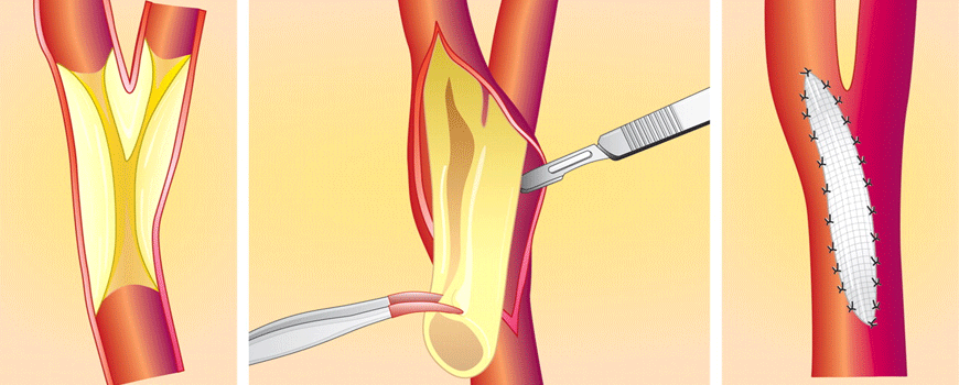 Lečenje asimptomatske stenoze karotidne arterije