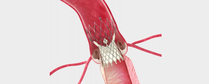 Primena TAVR kod niskorizičnih pacijenata