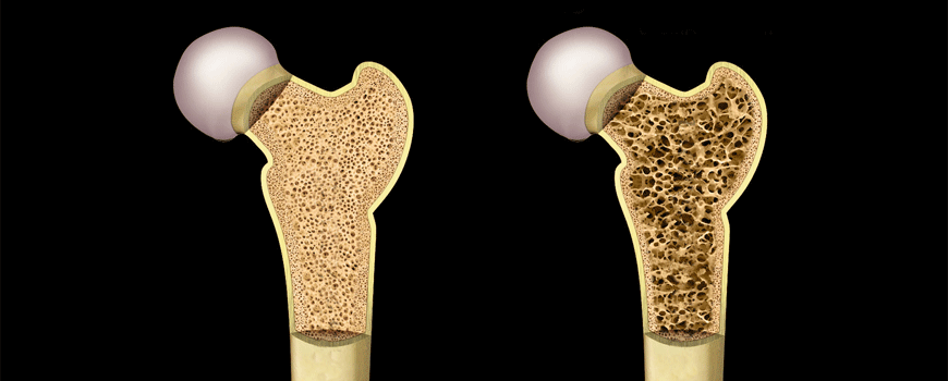 Abaloparatid u prevenciji fraktura kod postmenopauzalnih žena