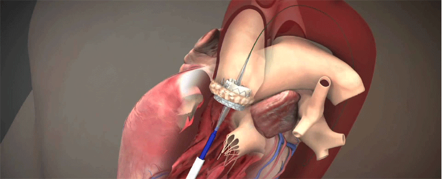 Bivalirudin vs. heparin kod TAVR