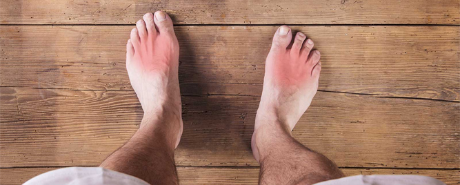 Prevencija cerebralnih i kardiorenovaskularnih događaja kod primene febuksostata