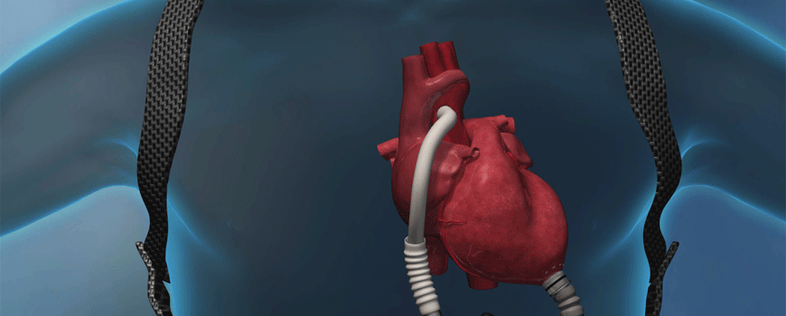 HeartMate3 vs. HeartMate2 potpora srcu