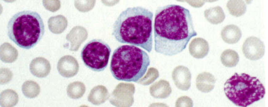 Ibrutinib vs. hlorambucil kod hronične limfocitne leukemije