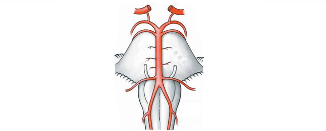 Okluzija vertebrobazilarne arterije – endovaskularno vs. medikamentno lečenje