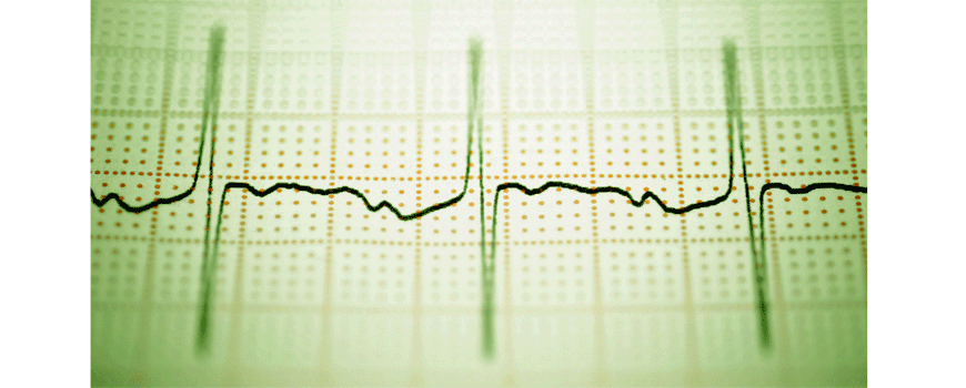 Flekainid + metoprolol u prevenciji ponovnog javljanja AF