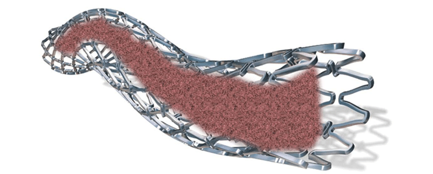 Lečenje in-stent restenoze