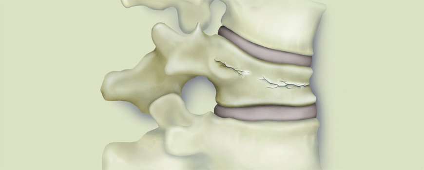 Romosozumab u terapiji osteoporoze