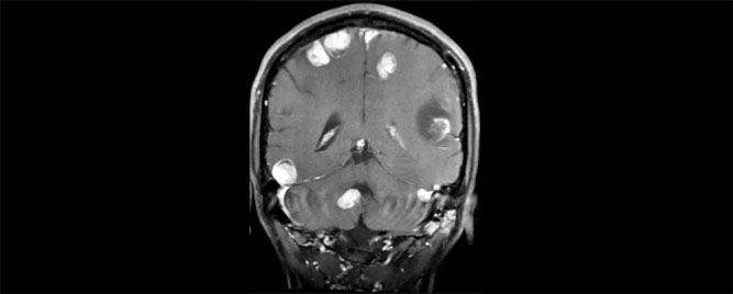 Pembrolizumab kod pacijenata sa metastazama melanoma na mozgu