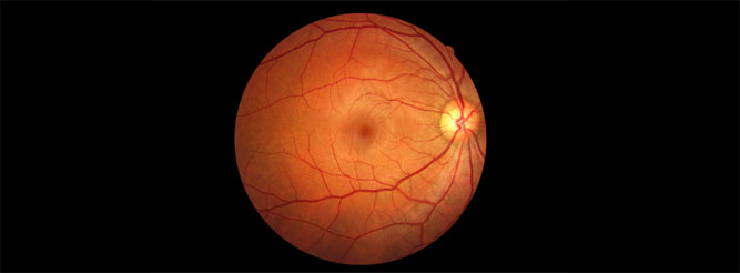 Statini pomažu i kod dijabetesne retinopatije