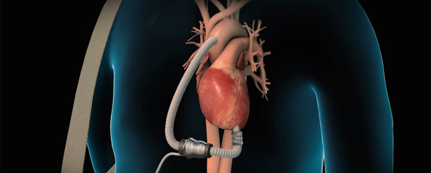 Centrifugalni vs. aksijalni protok LVAD